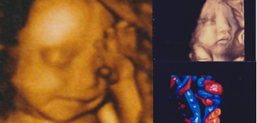 4 3D・4Dエコー(超音波検査)